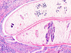 A section of the liver worm in the human bile ducts within the liver. Credit: Professor Banchob Sripa